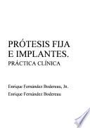 Prótesis fija e implantes